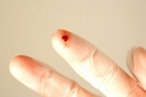Needle Stick Injury 2 Gloved finger with needle stick