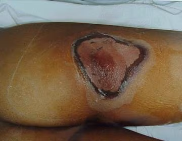 A human leg damaged by radiation in later stages.