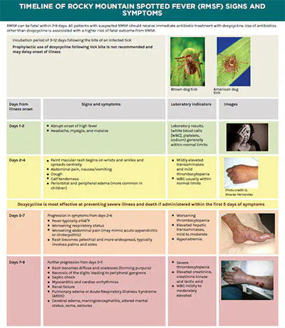 Clinical timeline for Rocky Mountain spotted fever A color chart providing key clinical facts and images to aid in the diagnosis of RMSF.