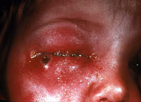 Smallpox Adverse Reaction Accidental Autoinoculation of Eyelid A very swollen and red child's eye