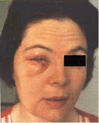 Smallpox Adverse Reaction Accidental Autoinoculation of Lower Eyelid A woman's face with a swollen and red eye