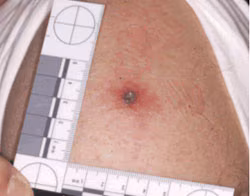 Smallpox Vaccine Take Reaction Central Lesion 1 Centimeter An upper arm with a lesion from smallpox vaccination