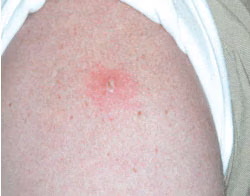 Smallpox Vaccine Take Reaction Central Lesion An upper arm with a rash and central lesion after smallpox vaccination