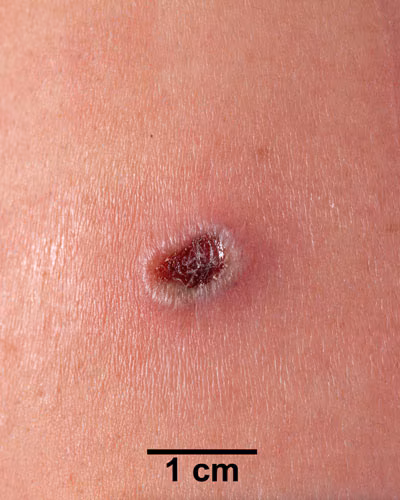 An arm with a dark red lesion