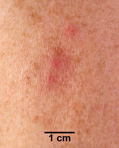 An arm with a small rash