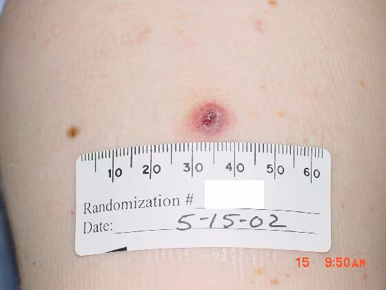 An upper arm with a red lesion and dark red center