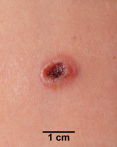 An arm with a dark red lesion