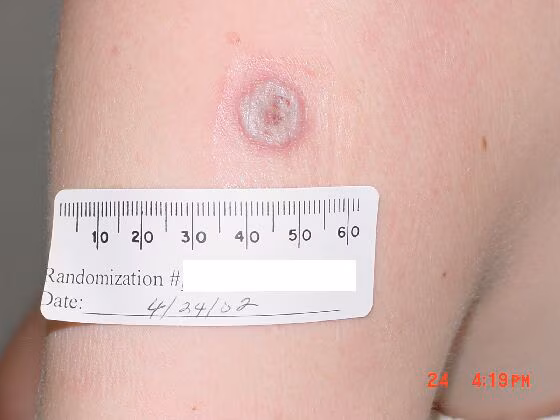 An upper arm with a grey lesion surrounded by a red ring, with a red center