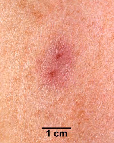 An arm with a red rash