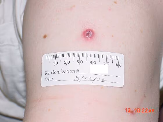 An upper arm with a red lesion and grey center