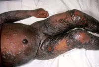 Smallpox Adverse Reaction Eczema Vaccinatum 2 A dark-skinned infant's torso and legs, covered in scabs and rash