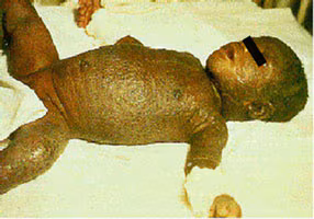 Smallpox Adverse Reaction Eczema Vaccinatum Unvaccinated Contact An infant lay on a bed, their torso, arms, legs, and head covered in rash and scabs