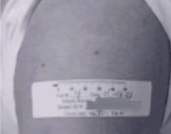 Vaccine Take Evaluation Erythema Nor Central Lesion An upper arm that has no erythema or central lesion after vaccination