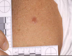 Vaccine Take Evaluation Erythema but No Central Lesion An upper arm with an erythema around the vaccination site