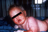 Smallpox Adverse Reaction Generalized Generalized Vacciniaaccinia An infant with a red rash all over