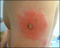 Robust Take A person's upper arm with a red rash around a smallpox vaccination site. A pustule is in the center.
