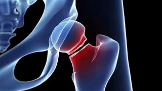 Hip fracture illustration Illustration of a hip fracture