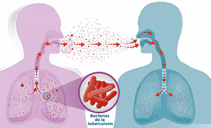 spanish-howTBspread How tuberculosis spreads